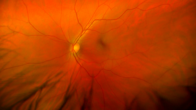 Zoomed in image of eye from diagnostic test